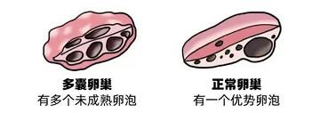 多囊卵巢综合征患者是否需要月经规律才能怀孕?