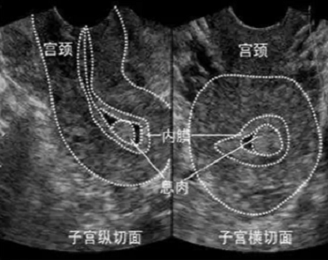成都子宫内膜回声不均是怎么回事？