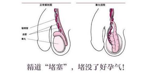 睾丸炎造成不育症的原因