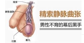 专家解读精索静脉曲张的症状
