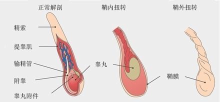 突发睾丸扭转怎么办？