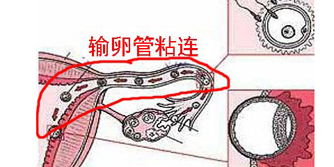 输卵管粘连怎么办?