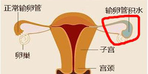 输卵管积水的检查方法