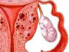 子宫腺肌症如何治疗？