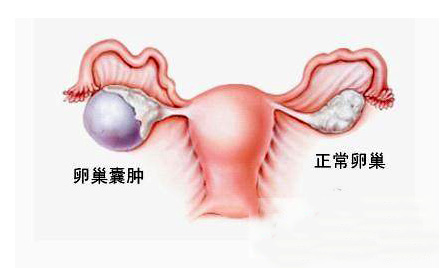 成都治疗卵巢囊肿的医院