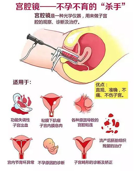 宫腔镜手术