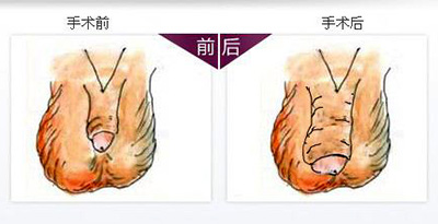 成都治疗阴茎增粗的医院