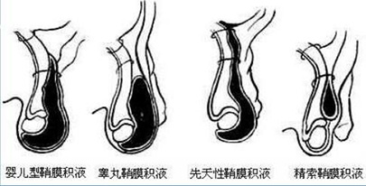 成都治疗鞘膜积液的生殖医院