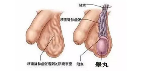 精索静脉曲张结扎术治疗率有多高？
